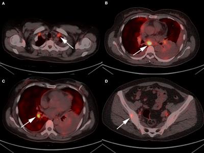 Secondary mutant ALK-I1171s in pituitary metastases from a patient with ALK fusion-positive advanced lung adenocarcinoma: A case report and literature review